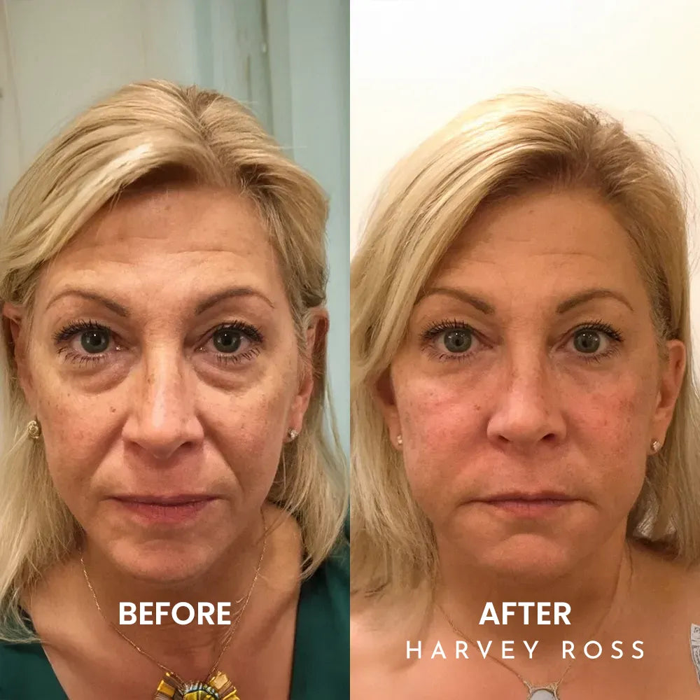 Harvey Ross - Instant Lift+